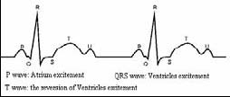 normal ecg sinus rhythm