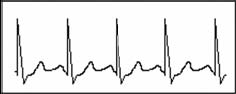 tachycardia rhythm
