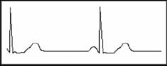 bradycardia rhythm