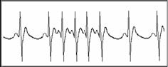 short run tachycardia