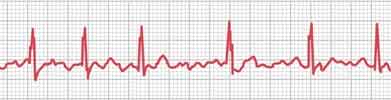 Atrial Fibrillation