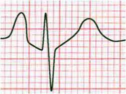 P Pulmonale