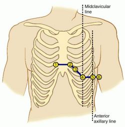 v-leads placement